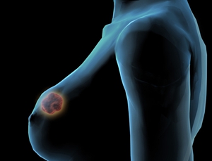 乳腺癌筛查 医师的判断很重要