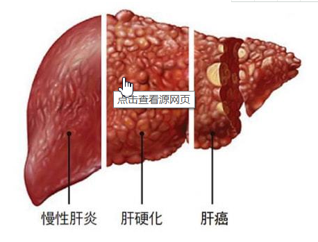 巨型肝癌怎么治疗效果好？
