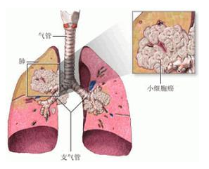 化疗能否消除癌细胞
