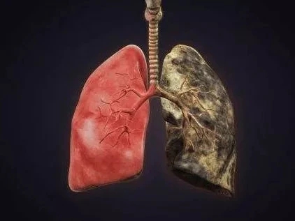 肺癌的自测方法