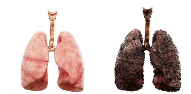 如何判断自己是否患有肺癌