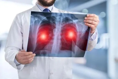 肺癌的早期症状
