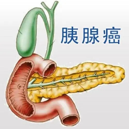 糖尿病人需警惕胰腺癌