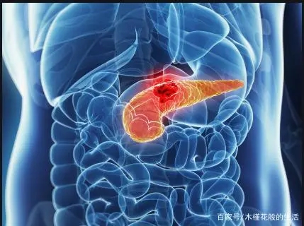 六类人易患胰腺癌