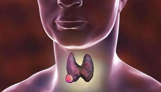 甲状腺瘤严不严重