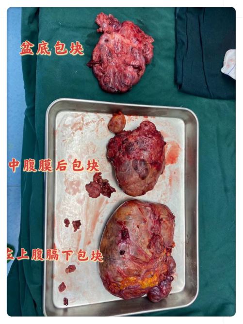咸阳肿瘤医院外科成功完成胃肠间质瘤切除术