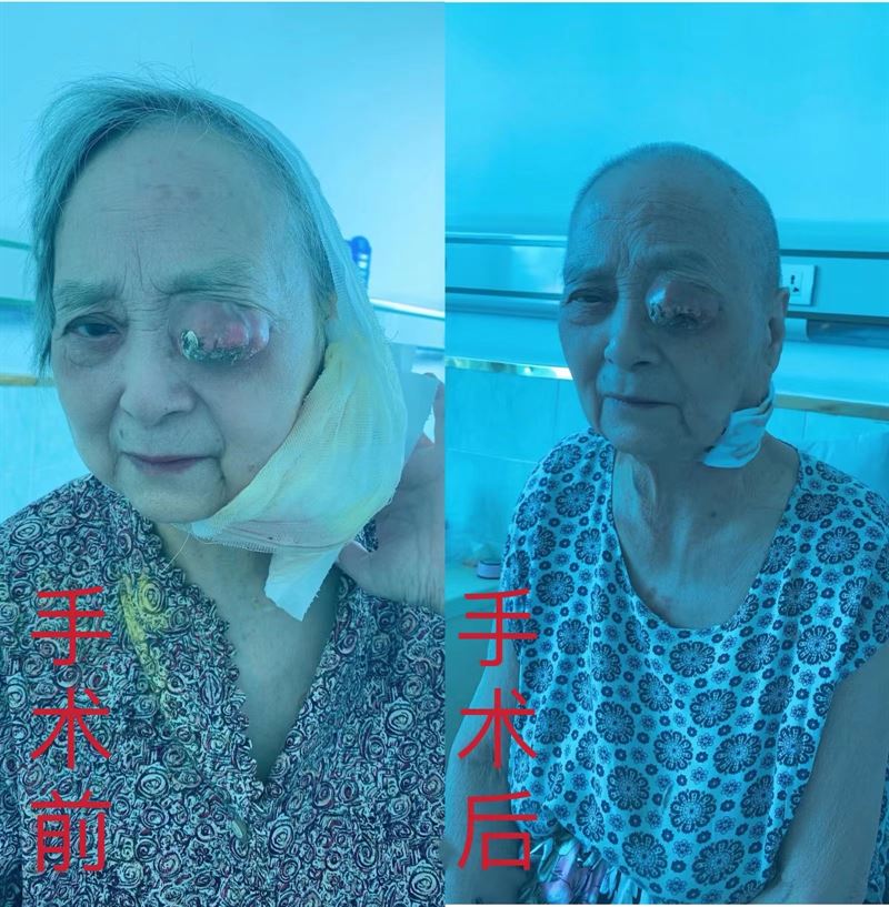 脖子上长着小儿头大恶性肿瘤的76岁老人如今怎么样了