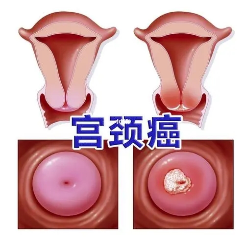 宫颈癌分几期