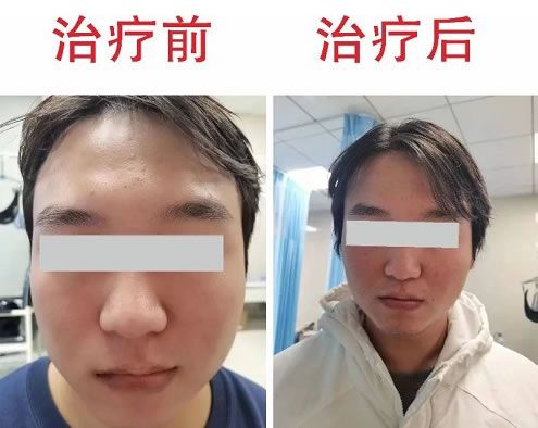 针灸配合中药治疗“面神经炎” — 咸阳肿瘤医院案例分享