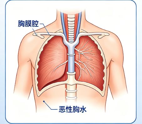 有效控制恶性胸水